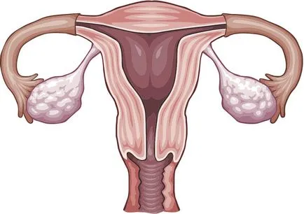 Fibromatoza a uterului ca o boală periculoasă și consecințele sale