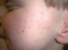 Keratosis pilaris a gyermek kezelés problémás bőrre