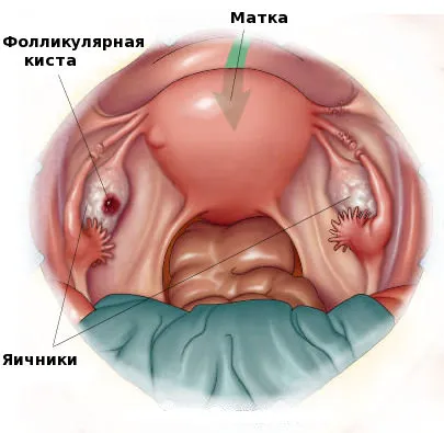 Фоликуларният киста на яйчниците