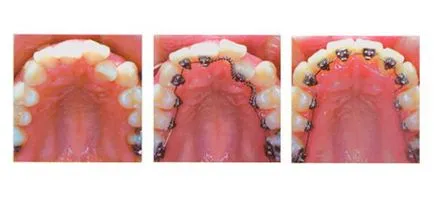 Fotografii înainte și după tratamentul cu aparat dentar