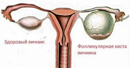Follicularis petefészek ciszta kezelés, a tünetek és okait