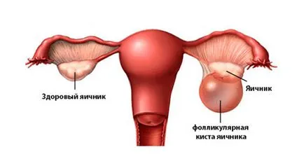 Фоликуларният киста на яйчниците