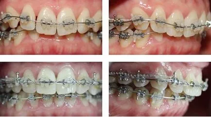 Fotografii înainte și după tratamentul cu aparat dentar