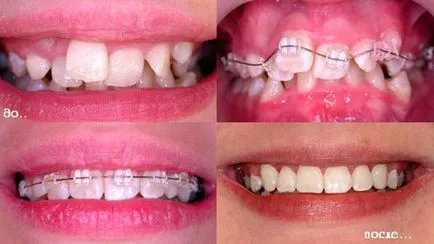 Fotografii înainte și după tratamentul cu aparat dentar