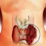 Хипоплазия на щитовидната жлеза като явна и дали да лекуват