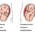 Ginipral sarcinii cerere instrucțiuni, comentarii, preț și analogi