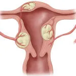 Nőgyógyászati ​​betegségek és endometriosis polip
