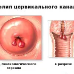 Гинекологични заболявания и ендометриоза полип