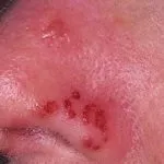 Simptome Herpes in nas, cauzele si tratamentul