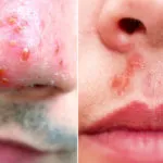 Simptome Herpes in nas, cauzele si tratamentul