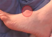 Higroma picior - simptome și tratament de tendon ganglionare (funcționare)