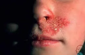 Herpes tünetek az orr, okok és a kezelés