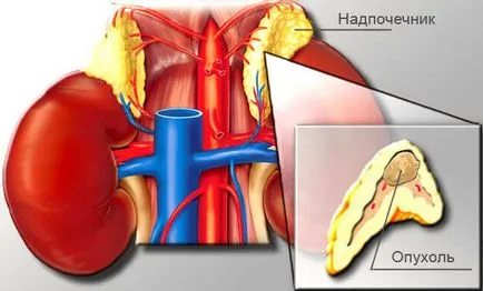 надбъбречна хиперплазия при възрастни
