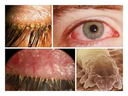 Eye atka tünetei, kezelése és okai Demodex, fotó és videó