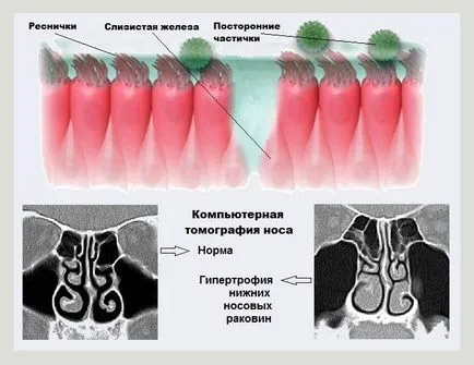 Hipertrofia mucoasei nazale - tratamentul răcelii comune