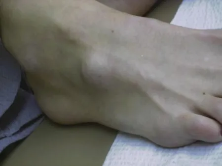 Hygroma a lábát tünetek és a kezelés