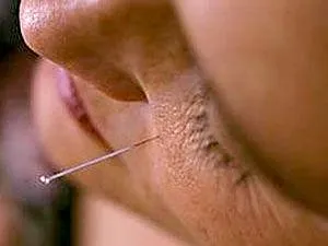 Acupunctura pentru balbismul