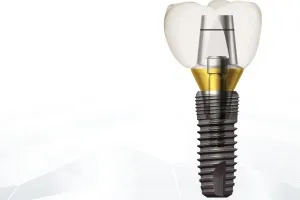 Az implantátumok implantium véleménye és a költség a beültetés