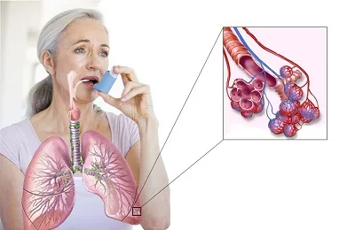 Inhalarea astmului utilizarea medicatiei si ce putem face pentru copii și adulți