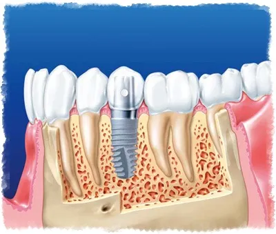зъб имплант, тъй като е направено всичко, на зъбите
