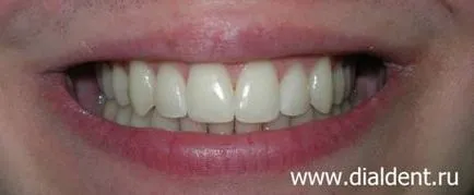 Isparavlenie ухапване и подравняване на избелване на зъбите възстановяване изкуство