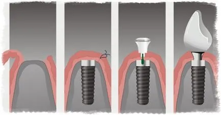 зъб имплант, тъй като е направено всичко, на зъбите