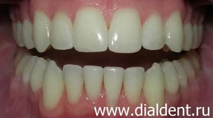 Isparavlenie ухапване и подравняване на избелване на зъбите възстановяване изкуство