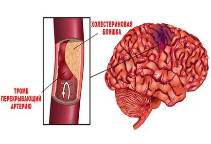 simptome de ischemie accident vascular cerebral, cauze, tratament, prevenire, tipuri și tipuri, medicina populară