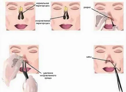 Curbura indicațiilor septul nazal, în special o intervenție chirurgicală, efectele