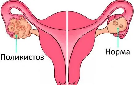 Túlzott szőrnövekedés a test és az arc a nők okoz, kezelés