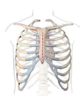 Какви видове стернотомия - функции и характеристики на работата, рехабилитация след