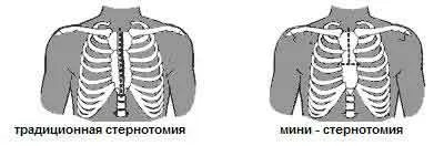 Какви видове стернотомия - функции и характеристики на работата, рехабилитация след
