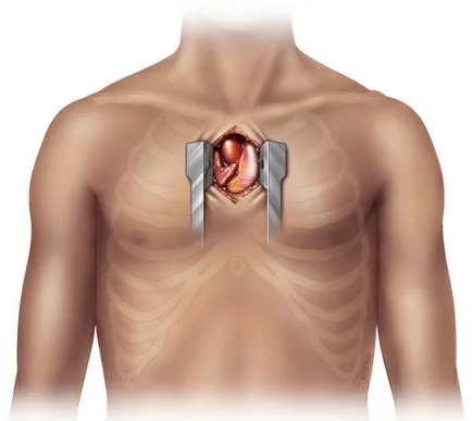 Какви видове стернотомия - функции и характеристики на работата, рехабилитация след