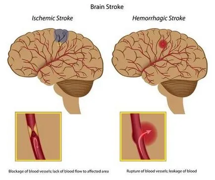 Cum de a evita un accident vascular cerebral vestitorii bolii și metodele de prevenire