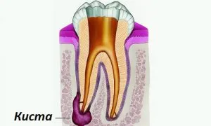 Как е кореновата киста