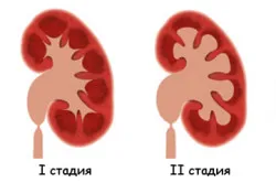 Hidronefroză în clasificarea copii, etapa, tratament