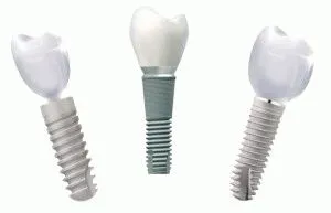 În cazul în care pentru a instala implanturi dentare germane de la Moscova, o imagine de ansamblu a implanturilor, clinici cu preturi