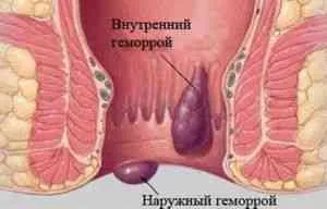 Scoaterea atacul de hemoroizi - hemoroizi agravarea -dacă () - ENDIF - Articole Director - Proctologie -