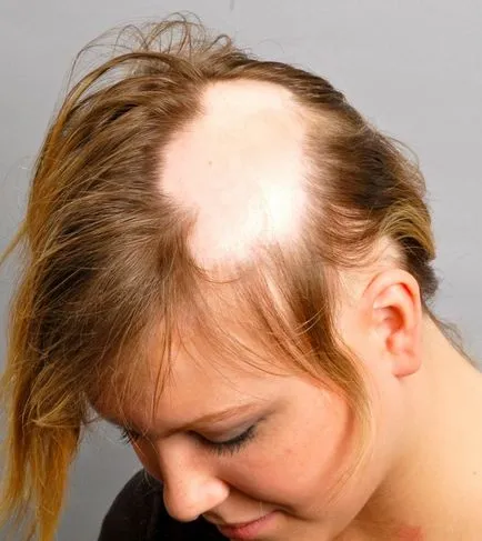 Alopecia areata cum să trateze