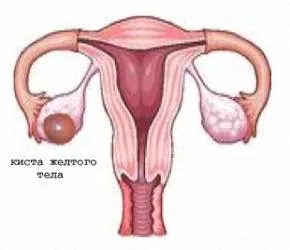 Chist ovarian simptome ale corpului galben, tratament, sarcina