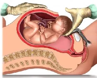 Цезарово сечение плюсове и минуси, предимства и недостатъци на цезарово сечение и естествено раждане секцио