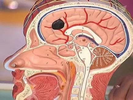 Brain киста Причини, симптоми и лечение