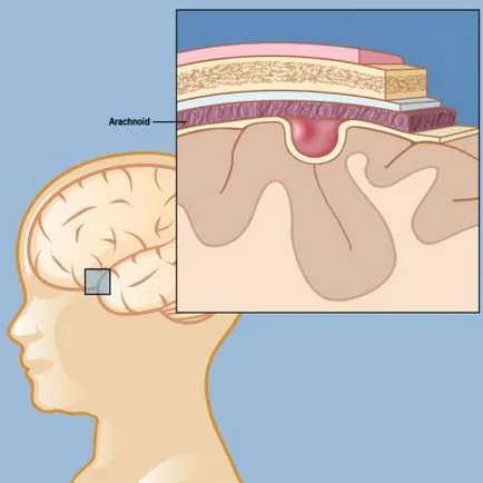 Brain киста Причини, симптоми и лечение