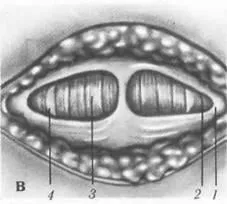 Pfannenstiel laparotomie de 1