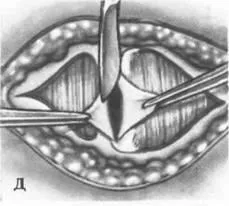 Pfannenstiel laparotomie de 1