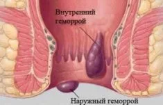 tratament hemoroizi acasă, cum să scapi de hemoroizi la domiciliu