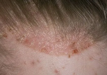 Babérlevél psoriasis