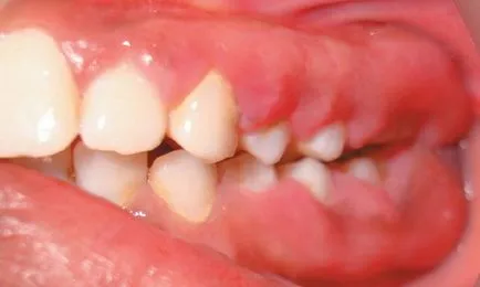 Tratamentul gingivitelor hyperplastic - Enciclopedia dentara
