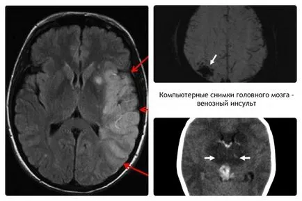 Tratamentul trombozei venoase, spre deosebire de alte tipuri de accident vascular cerebral