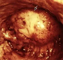 fibrom uterin si tratamentul cu terapia cu ultrasunete